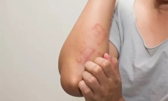 Làm cách nào để phân biệt phát ban do COVID-19 và đậu mùa khỉ?