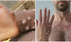  Đồng Nai: Ghi nhận một ca bệnh dương tính với virus đậu mùa khỉ