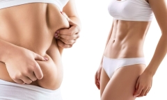 Hút mỡ bụng có để lại sẹo không?