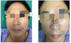 Nốt ruồi giữa sống mũi, tưởng sẽ “mang lại vận khí tốt” ai ngờ là dấu hiệu ung thư