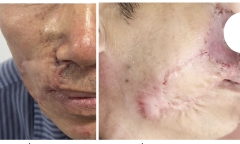 “Mổ đi mổ lại” vẫn tái phát: Bác sĩ cảnh báo ung thư da âm thầm xâm lấn