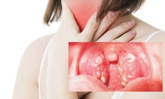Bệnh bạch hầu lây như thế nào? Cách phòng tránh bệnh bạch hầu
