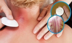Vì sao mỏi người, trúng gió khi thay đổi thời tiết lại dùng đồ bạc đánh gió