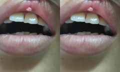 Hà Nội: Cô gái 23 tuổi mắc sùi mào gà ở miệng sau khi quen bạn trai qua mạng