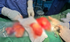 Người đàn ông mang khối u tinh hoàn 