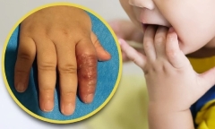 Làm theo mẹo trên mạng nhằm ngăn con 11 tháng mút tay, người mẹ suýt gây họa