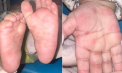 Con nổi nốt đỏ ở lòng bàn tay, mẹ