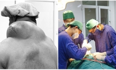 Phẫu thuật thành công khối u mỡ “khủng” nặng 1,5kg cho người đàn ông 50 tuổi