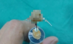Mảnh xương cá sắc nhọn mắc trong đường thở của bệnh nhi 2 tuổi