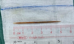 Tăm tre dài 5cm đâm thủng 2 lỗ ở tá tràng của bé trai 8 tuổi