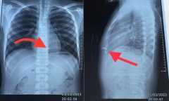 Pháo tự chế phát nổ, nhiều mảnh kim loại văng vào ngực trái thiếu niên 14 tuổi