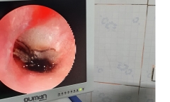 Một con gián được phát hiện còn sống trong tai bé trai 2 tuổi