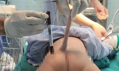 Phẫu thuật thành công đuôi dị tật dài 14cm cho một bệnh nhi 4 tháng tuổi