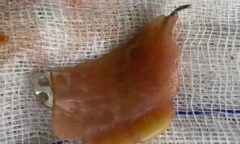 Tin tức đời sống ngày 30/7: Hàm răng giả cắm ngang thực quản bệnh nhân 37 tuổi