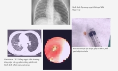 Tin tức đời sống ngày 5/2: Hạt lạc mắc kẹt gần một tháng trong khí quản bé 18 tháng tuổi