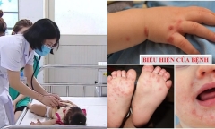 Cả nước ghi nhận hơn 100.000 trường hợp mắc tay chân miệng, 22 ca tử vong