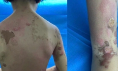 Bà nội có hành động khiến cháu gái 7 tuổi toàn thân nổi đầy mụn nước đau đớn, không thể ngồi bình thường
