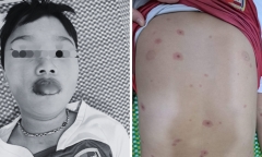 Tự uống thuốc ho tại nhà, bé trai loét môi miệng, nổi phát ban và diễn biến nặng