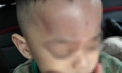 Nghi án bé 4 tuổi bị bạo hành tại trường mầm non ở Đà Nẵng