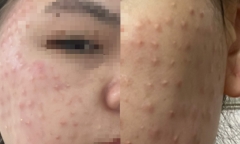 Mặt chi chít nốt sần trắng sau 2 tuần tiêm chất làm đẹp da miễn phí