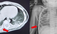 Ngã từ trên giường xuống nền nhà, bé trai 1 tuổi vỡ khí quản