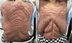 Người phụ nữ da nổi vết rạn như da rắn vì bôi thuốc trị ngứa mua trên mạng
