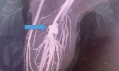 Bé trai 11 tuổi suýt phải cắt chân vì bị kéo đâm trúng khi đang chơi với em