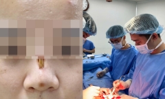 Bi hài hậu vận sau thẩm mỹ: Làm đẹp ở cơ sở gần nhà, sống mũi cô gái mưng mủ, lộ rõ sợi chỉ