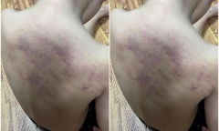 Tình tiết mới vụ bé 5 tuổi bị bầm tím khi đi học ở Hải Phòng: Quận báo cáo gì?