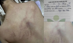 Vụ bé gái 4 tuổi bị đánh, kéo lê ở trường mầm non: Công an vào cuộc, tiết lộ về nữ giáo viên thứ 2 bị đình chỉ