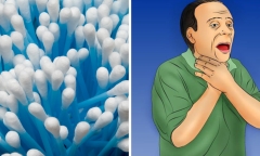 Nguy kịch do tăm bông ngoáy tai mắc ở khí quản