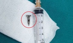 Tin tức đời sống ngày 14/8: Bé 22 tháng tuổi bị đinh vít 1,5cm găm vào phế quản