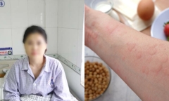 Nghĩ sau 20 năm hết dị ứng, cô gái trẻ phải đi cấp cứu vì sốc phản vệ