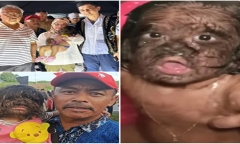 Bé gái 2 tuổi mắc 