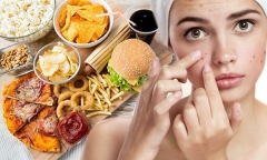 6 loại thực phẩm nhất định phải tránh khi bị mụn trứng cá