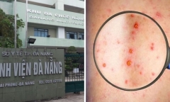 Đà Nẵng: Thực hiện cách ly ca nghi mắc bệnh đầu mùa khỉ
