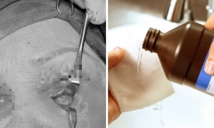 Dùng oxy già tẩy trắng răng để tiêm filler trẻ hóa, người phụ nữ hoại tử mi mắt