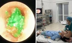 Gắp dị vật là sáp màu trong tai bé trai do bạn nhét vào khi chơi đùa