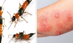 Cô gái 29 tuổi sốc phản vệ mức độ nặng vì kiến ba khoang đốt