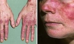 Bệnh Lupus ban đỏ có nguy hiểm không, biến chứng và cách phòng ngừa như thế nào?