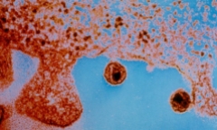 Nữ bệnh nhân HIV đầu tiên trên thế giới được chữa khỏi nhờ cấy ghép tế bào gốc mới