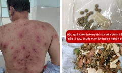 Rùng mình hậu quả tự chữa bệnh bằng đắp lá cây, thuốc nam không rõ nguồn gốc