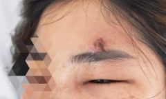 Cô gái 32 tuổi phải nhập viện vì “lỡ dùng tay” nặn mụn dẫn đến viêm mô bào