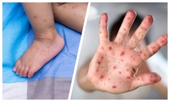 Bộ Y tế: Sốt xuất huyết, tay chân miệng, sởi đang có xu hướng gia tăng