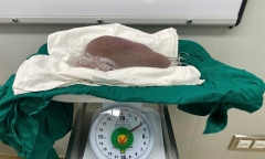 Bóc khối u nặng 3,2 kg trong người nữ điều dưỡng 23 tuổi