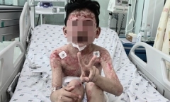 Bệnh nhi mắc triệu chứng hiếm gặp sau khi ăn cua 2 ngày