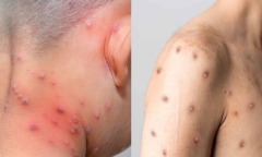 Những dấu hiệu để phân biệt bệnh đậu mùa khỉ và thủy đậu