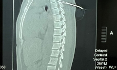 Nam thanh niên bị mũi tên bắn cá dài 7cm đâm xuyên tủy