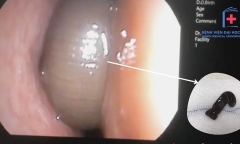 Chảy máu cam 3 tháng, người đàn ông đi khám thì phát hiện con đỉa dài 6cm còn sống trong hốc mũi
