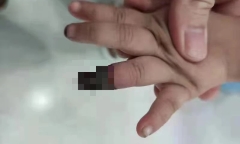 Cháu gái 3 tuổi bị đứt tay, bà dùng cách này cầm máu khiến bác sĩ buộc phải cắt cụt ngón đứa trẻ